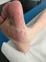 arterielle Embolien
