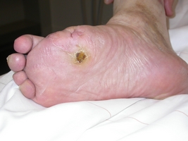 Mal Perforans / Ulcus