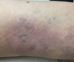 Phlebitis