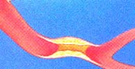 Arterienverengung